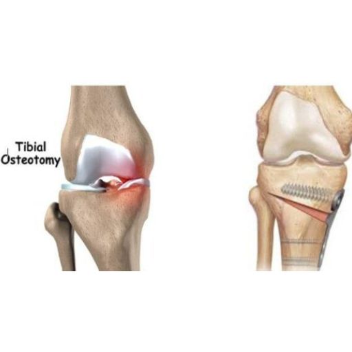 Recostruccion de ligamentos