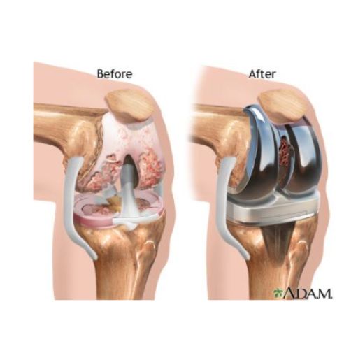 Reemplazo total rodilla