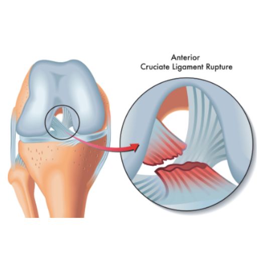 Recostruccion de ligamentos