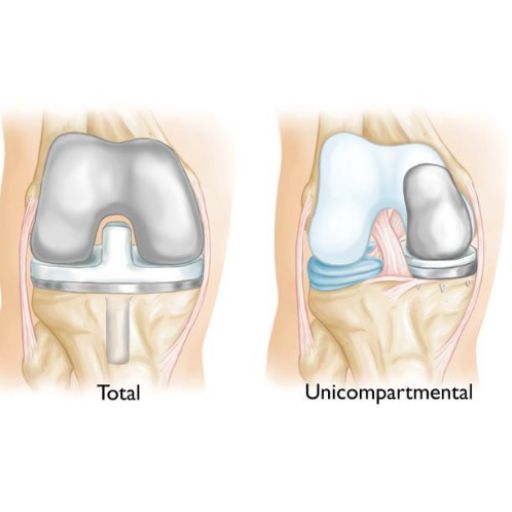 Reemplazo Unicompartimental